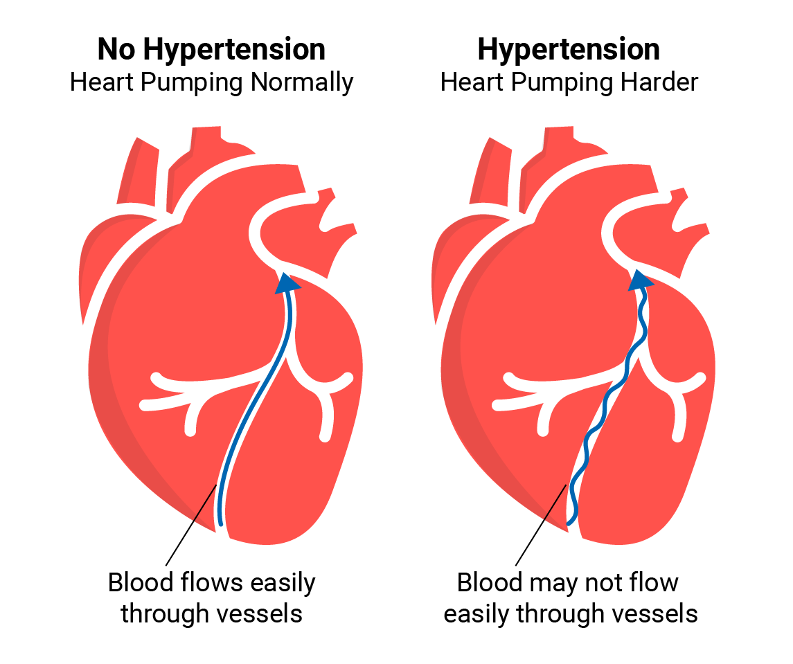 Hypertension Management Guidelines Clinical Info Bd