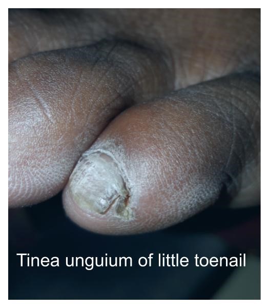 Tinea unguium effecting the toe nails. Diagnosis: Onychomycosis