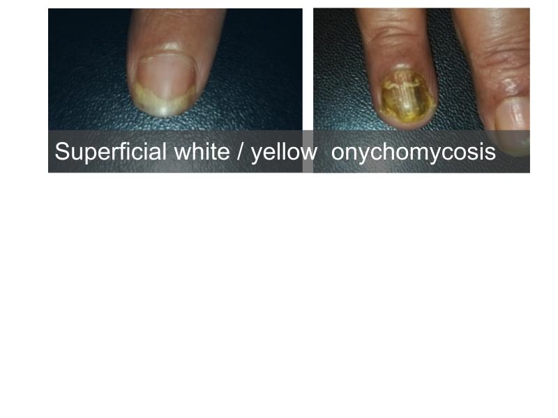 VW Dermatology - Onychomycosis, also known as tinea unguium, is a
