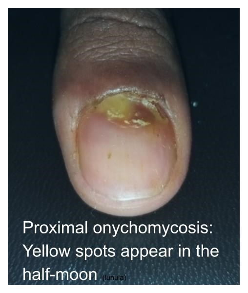 Elmicrobiologist - 👉 Onychomycosis (tinea unguium) Onychomycosis