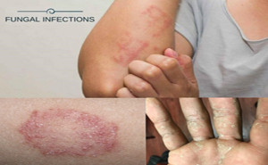 Fungus infection called Tinea manus on the hand. Also known as